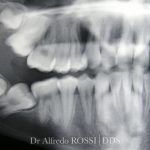 Radiografia dentale dei molari e dei premolari, con le radici visibili e un dente del giudizio incluso