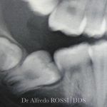 Radiografia dentale di molari e premolari con una radice del dente e un’otturazione visibili