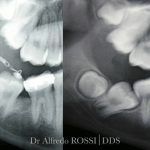 Radiografia dentale ravvicinata che mostra i molari e i denti in via di sviluppo nella mascella