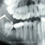Radiografia dentale dei molari e della mandibola, con uno strumento odontoiatrico visibile sul lato sinistro