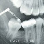 Radiografia dentale dei molari con una sonda che esamina un dente e una corona dentale visibile