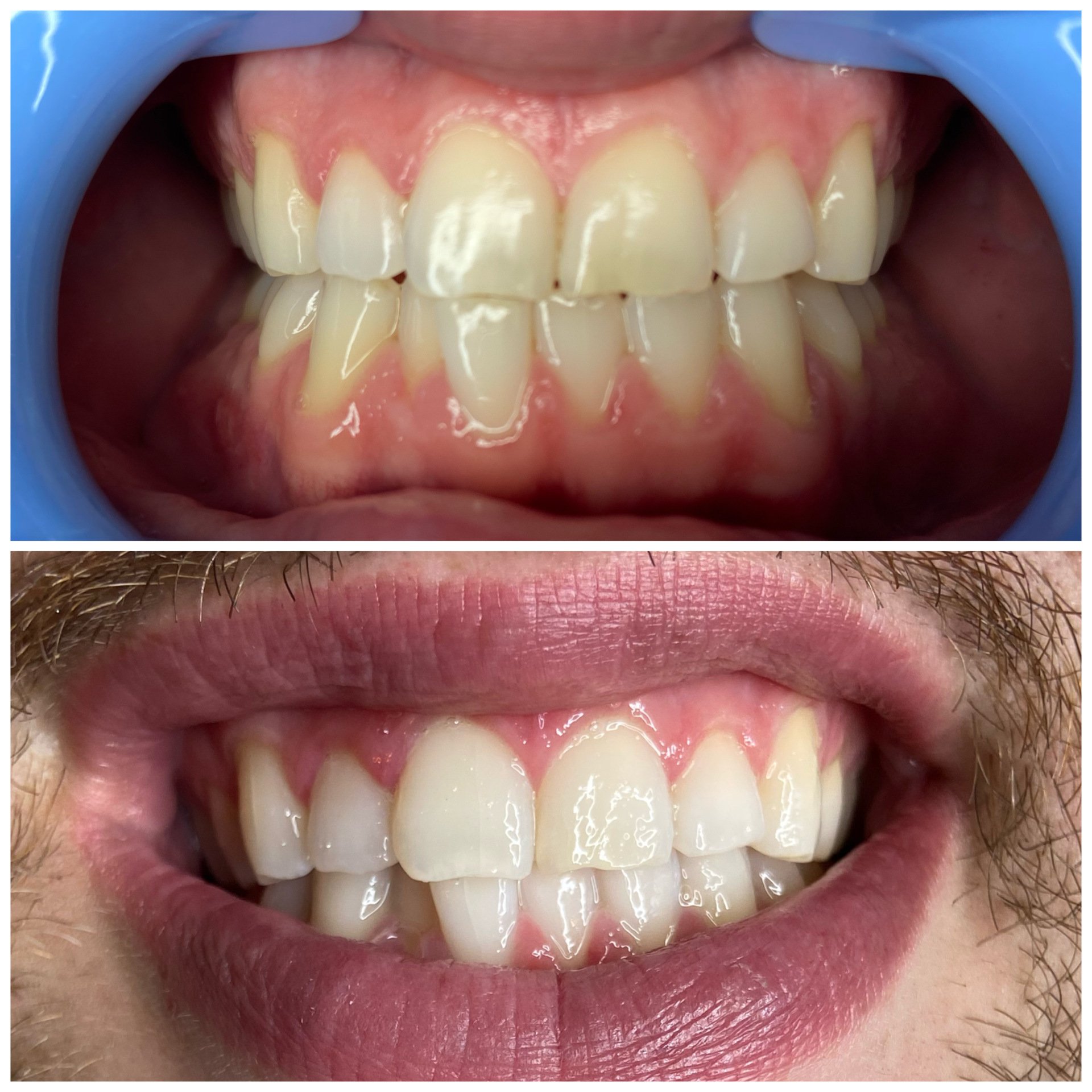 Cosmetic Laser Teeth Whitening Eugene, Oregon Alora