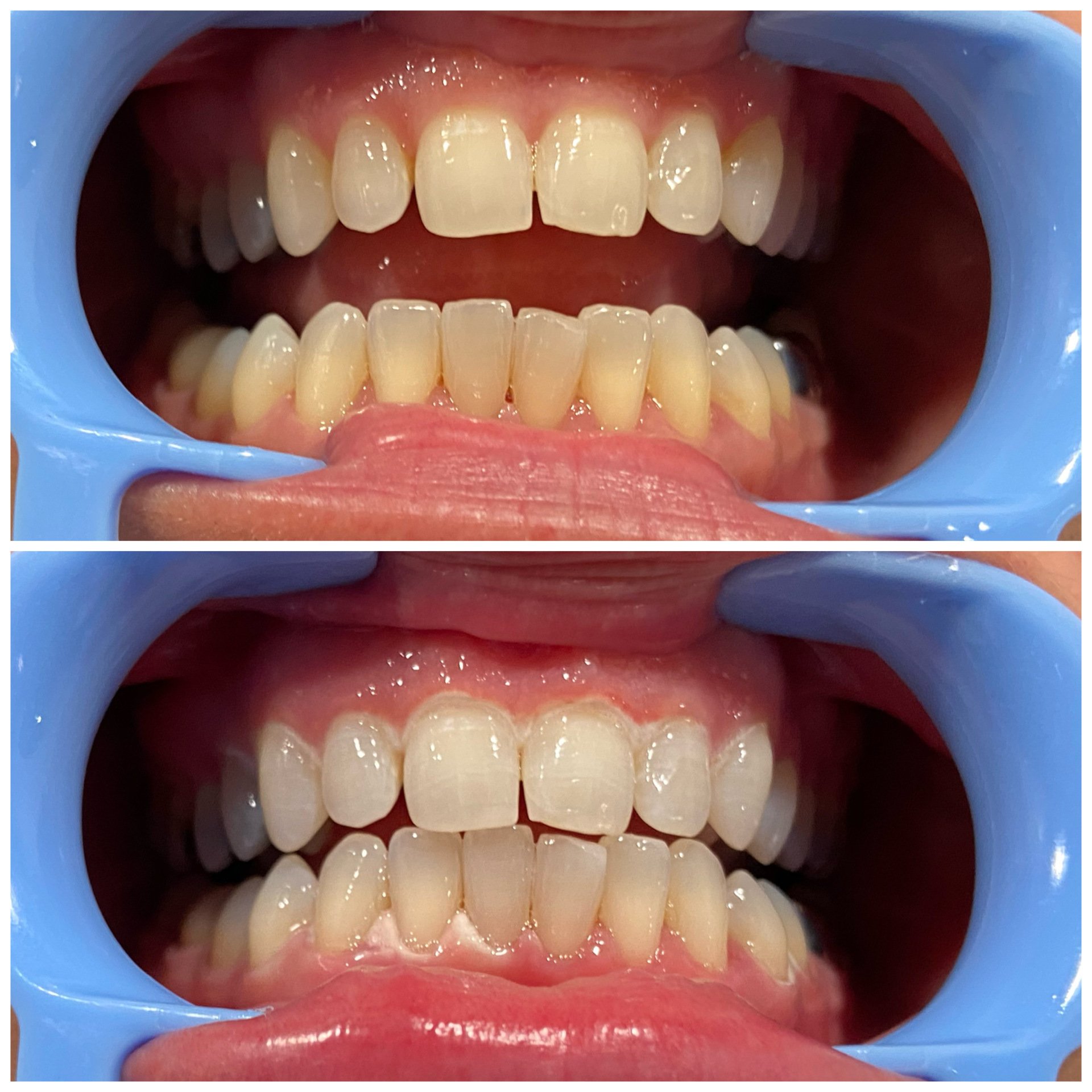 Cosmetic Laser Teeth Whitening Eugene, Oregon Alora