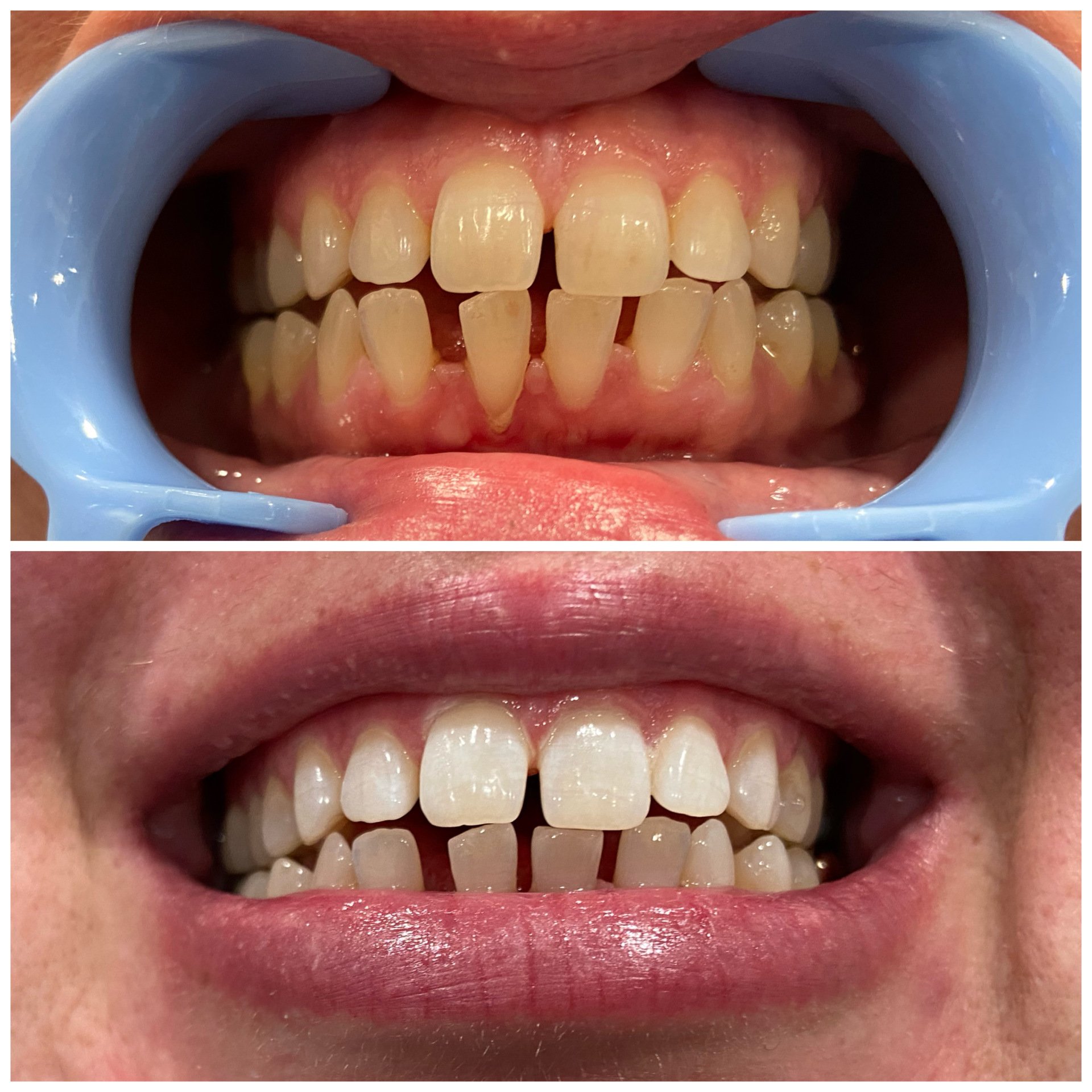 Cosmetic Laser Teeth Whitening Eugene, Oregon Alora