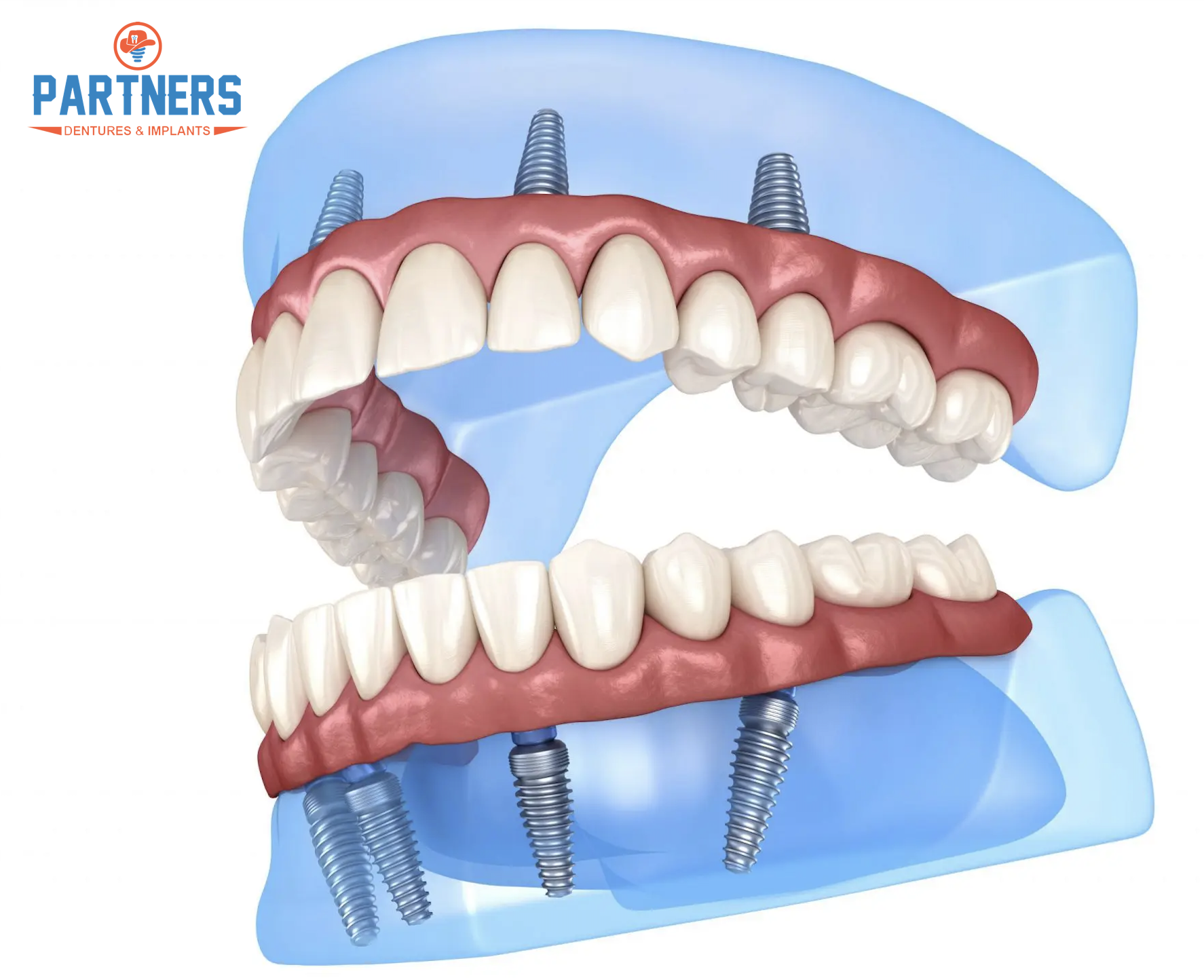 Partners Dentures & Dental Implants The Woodlands, TX | Best Rated