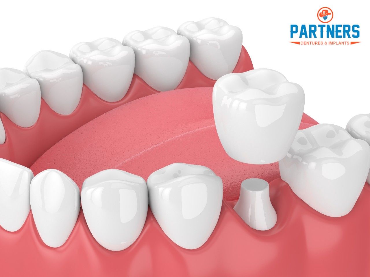 Dental Implants Woodlands TX