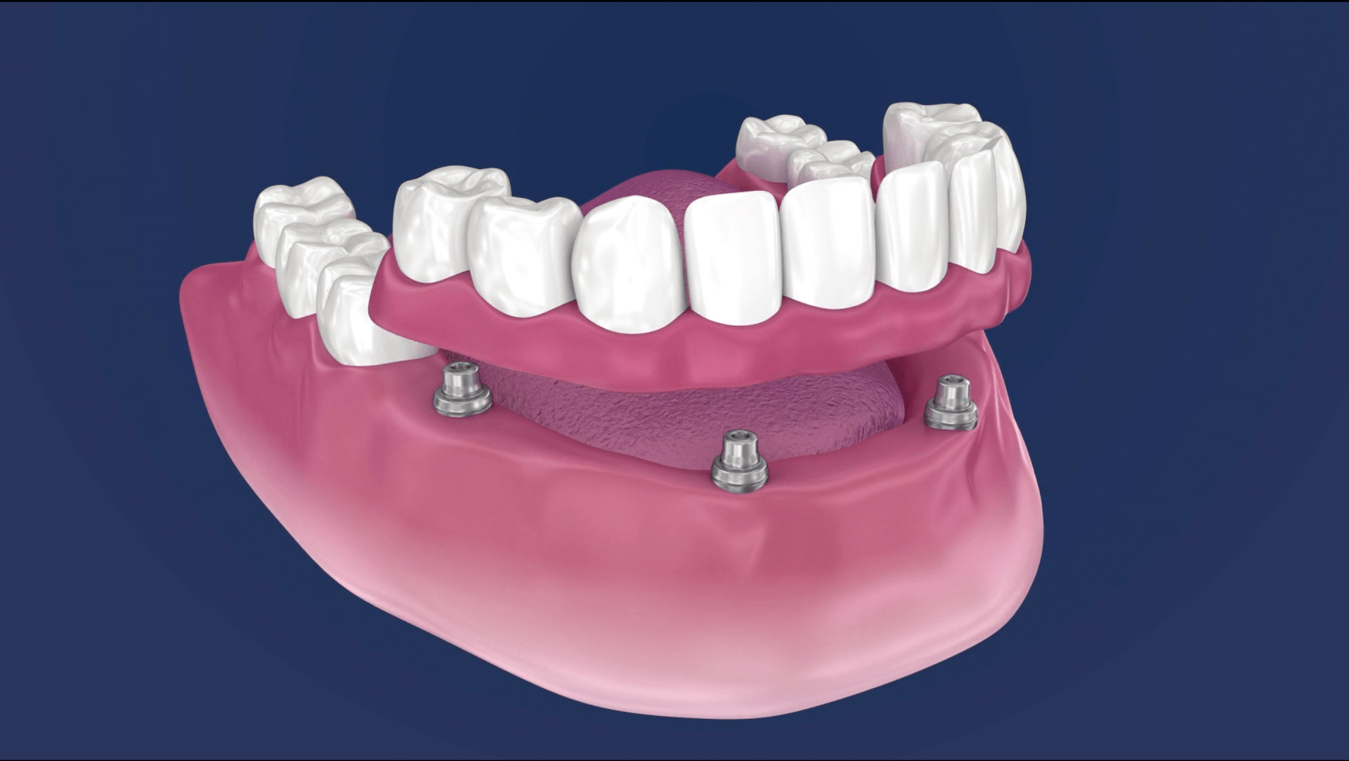 All on 4 dental implants Woodlands, TX