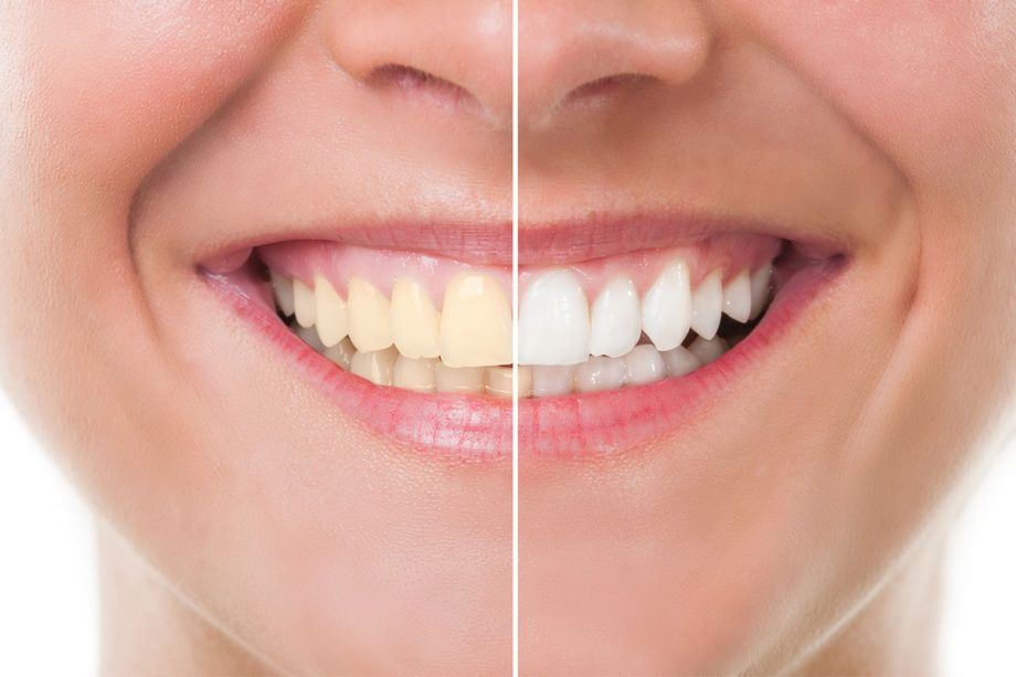Dental Implants Woodlands TX