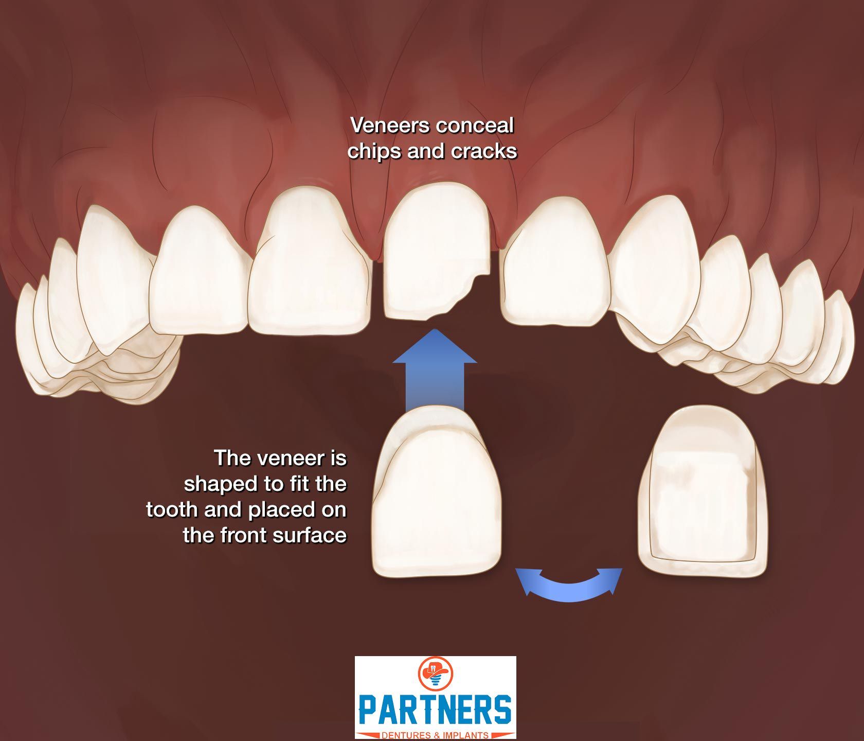 Dental Implants Woodlands TX