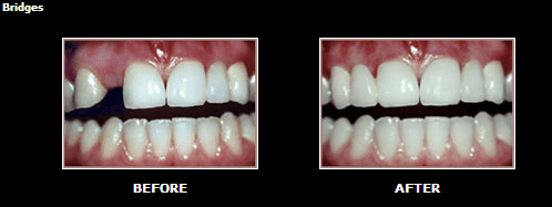 Before and After Image of Bridges