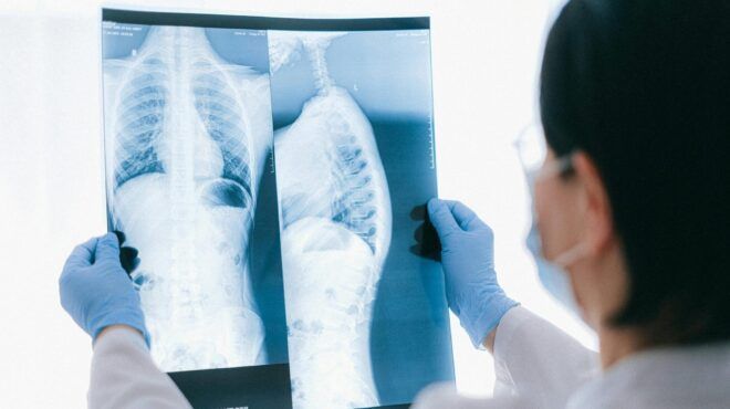Healthcare worker examining chest X-ray film held up to the light