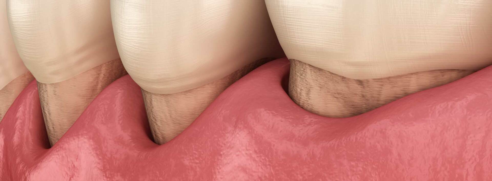 Emdogain Treatments for Gum Recession in Nassau County by Dr. Sfiroudis, a Leading Periodontist in Williston Park, NY 11596
