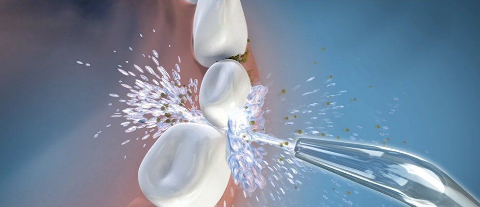 Waterpik Review: Cordless Professional Water Flosser