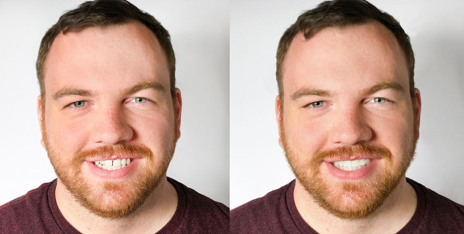 Adult Invisalign