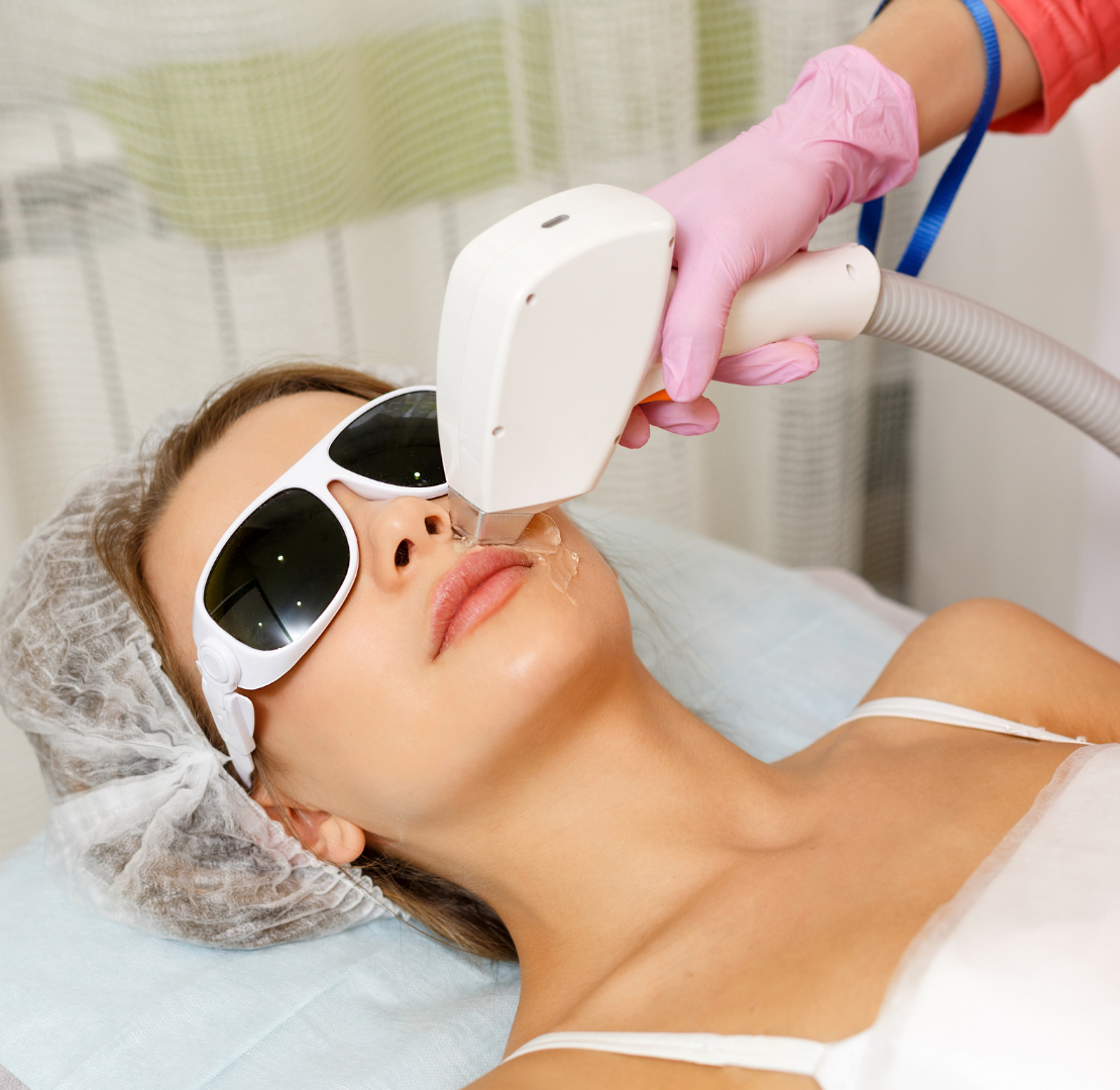 laser hair removal