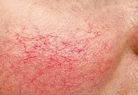 A close up of a person 's face with red veins.