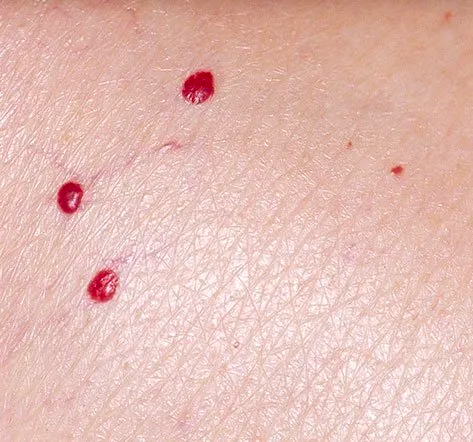 A close up of a person 's skin with red spots on it.