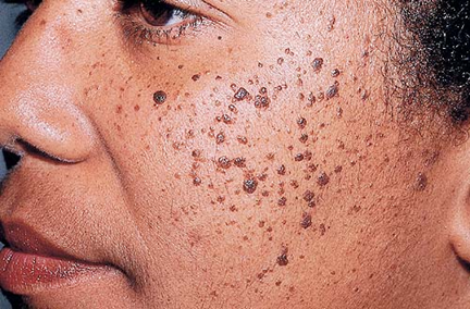 A close up of a woman 's face with a lot of freckles on it.