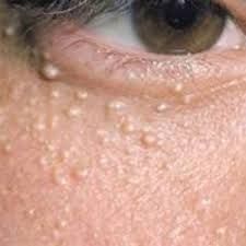 A close up of a person 's eye with a lot of white spots on it.