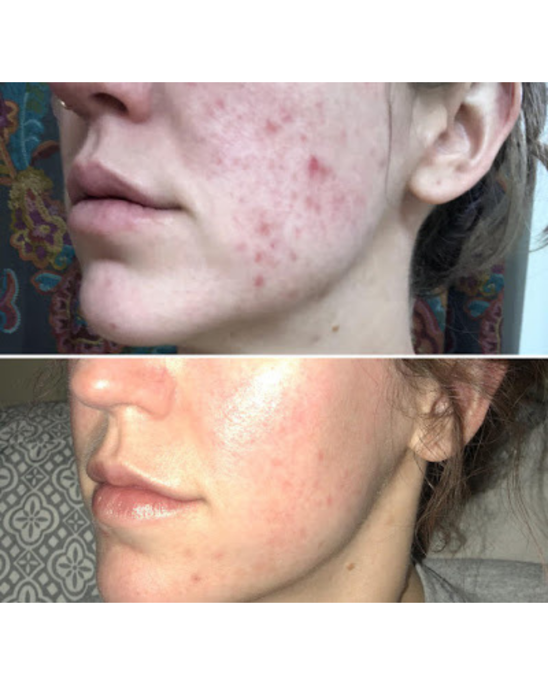 A before and after picture of a woman 's face with acne.