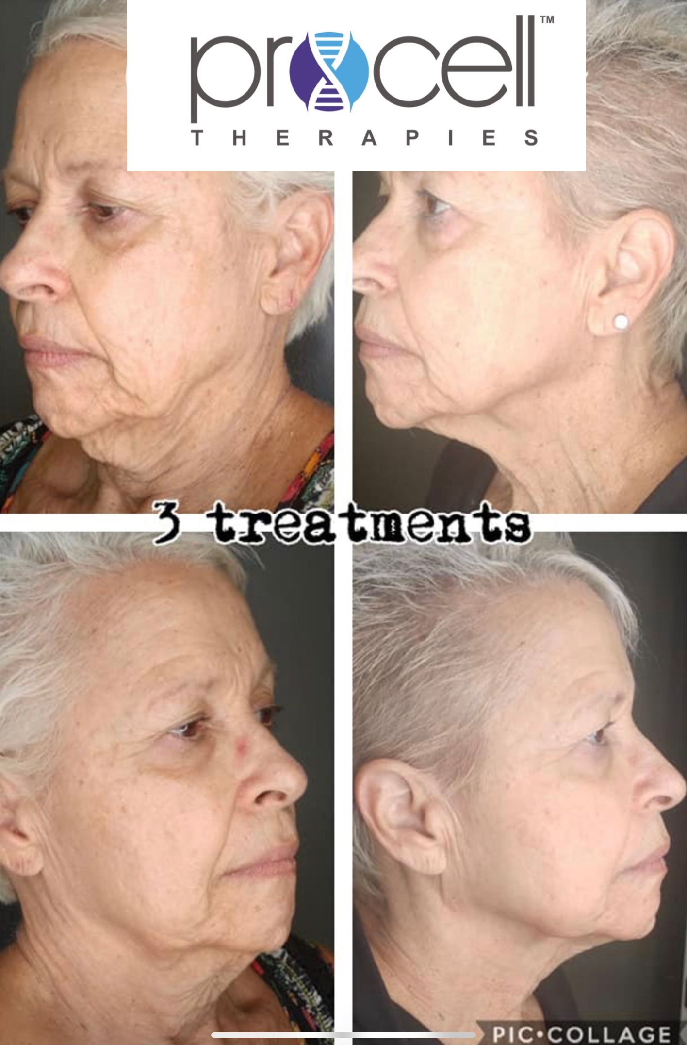 A woman 's face is shown before and after three treatments.