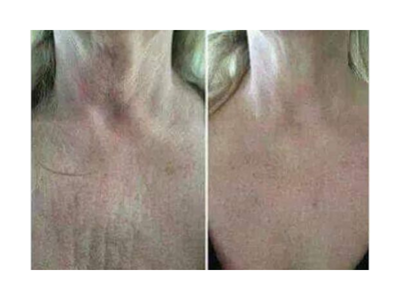 A before and after photo of a woman 's neck and chest.