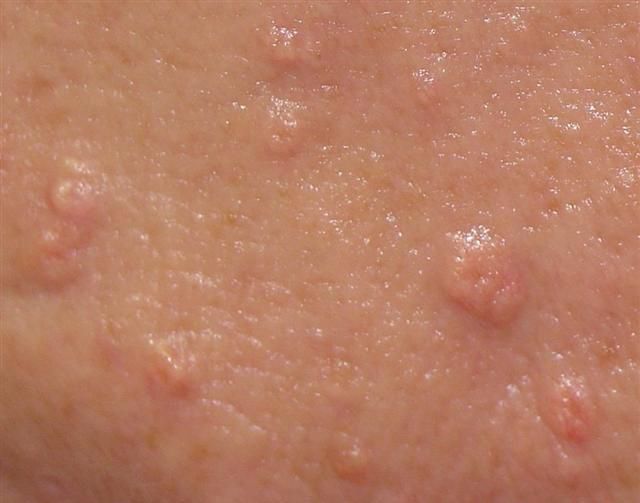 A close up of a person 's skin with bumps on it.