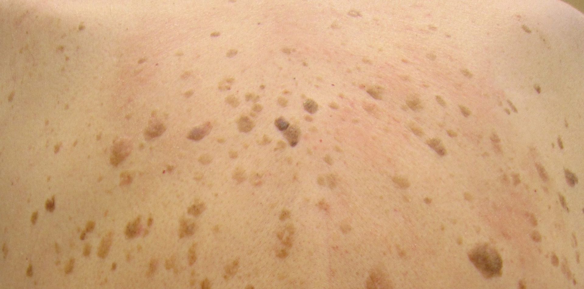 A close up of a person 's back with a lot of brown spots on it.