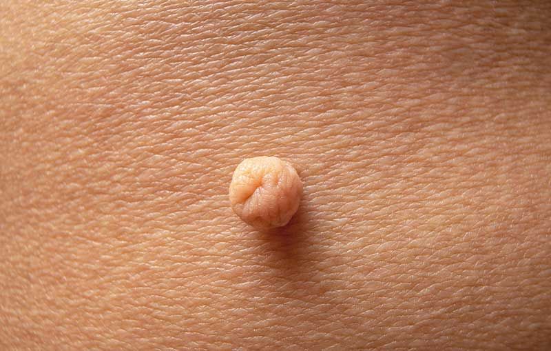 A close up of a mole on a person 's skin.