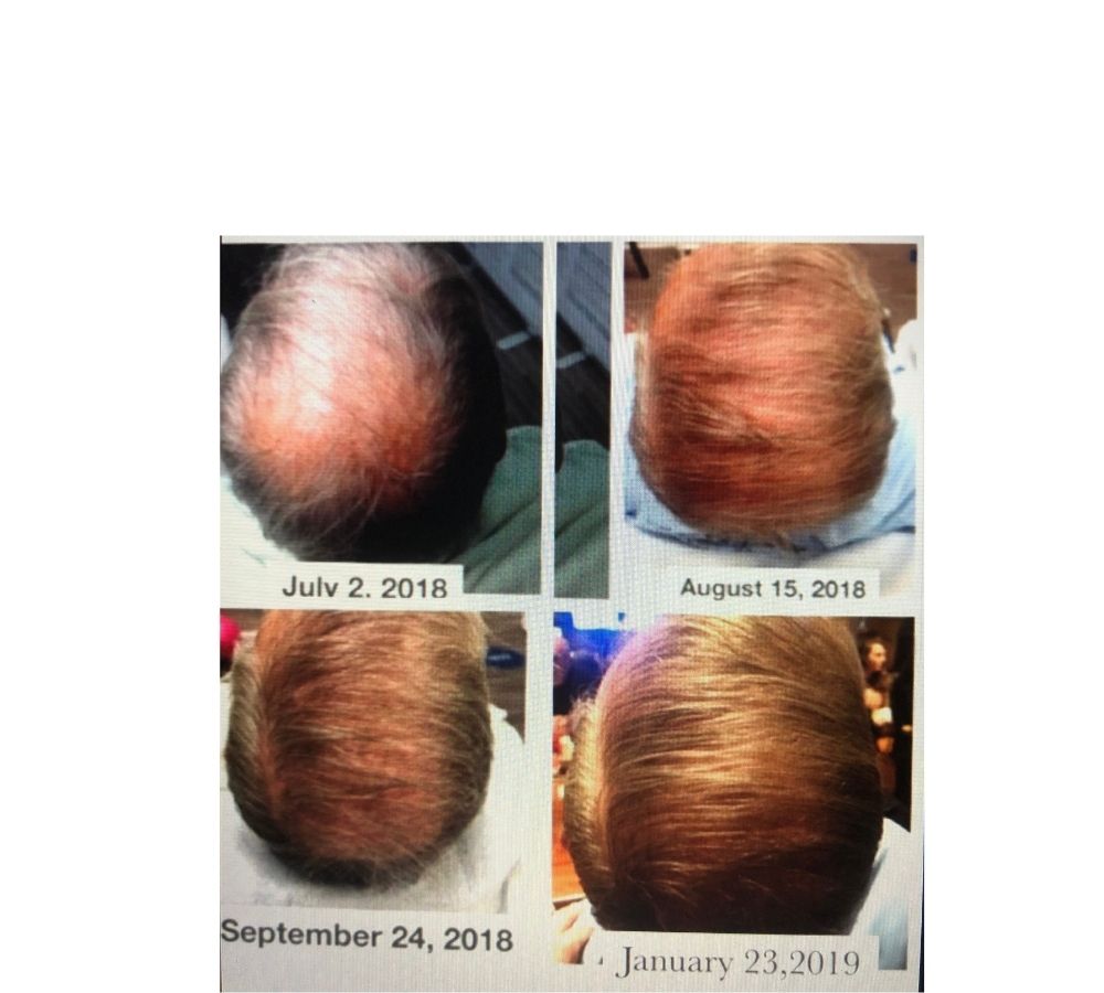 Four pictures of a man 's head showing hair loss from july 2 2018 to january 23 2019