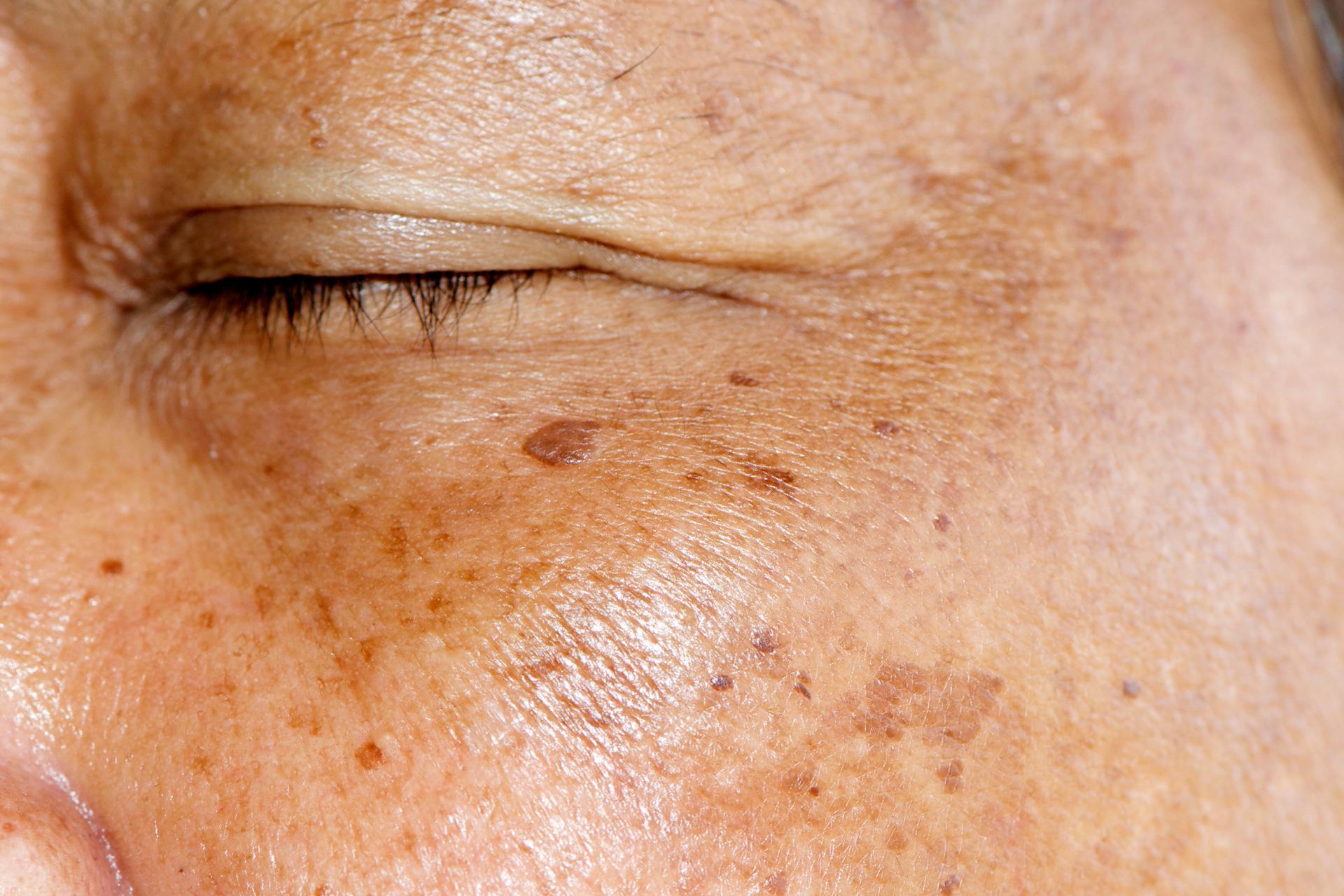 A close up of a woman 's face with freckles and a closed eye.