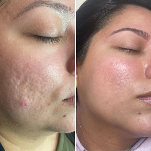 A woman 's face is shown before and after a treatment.