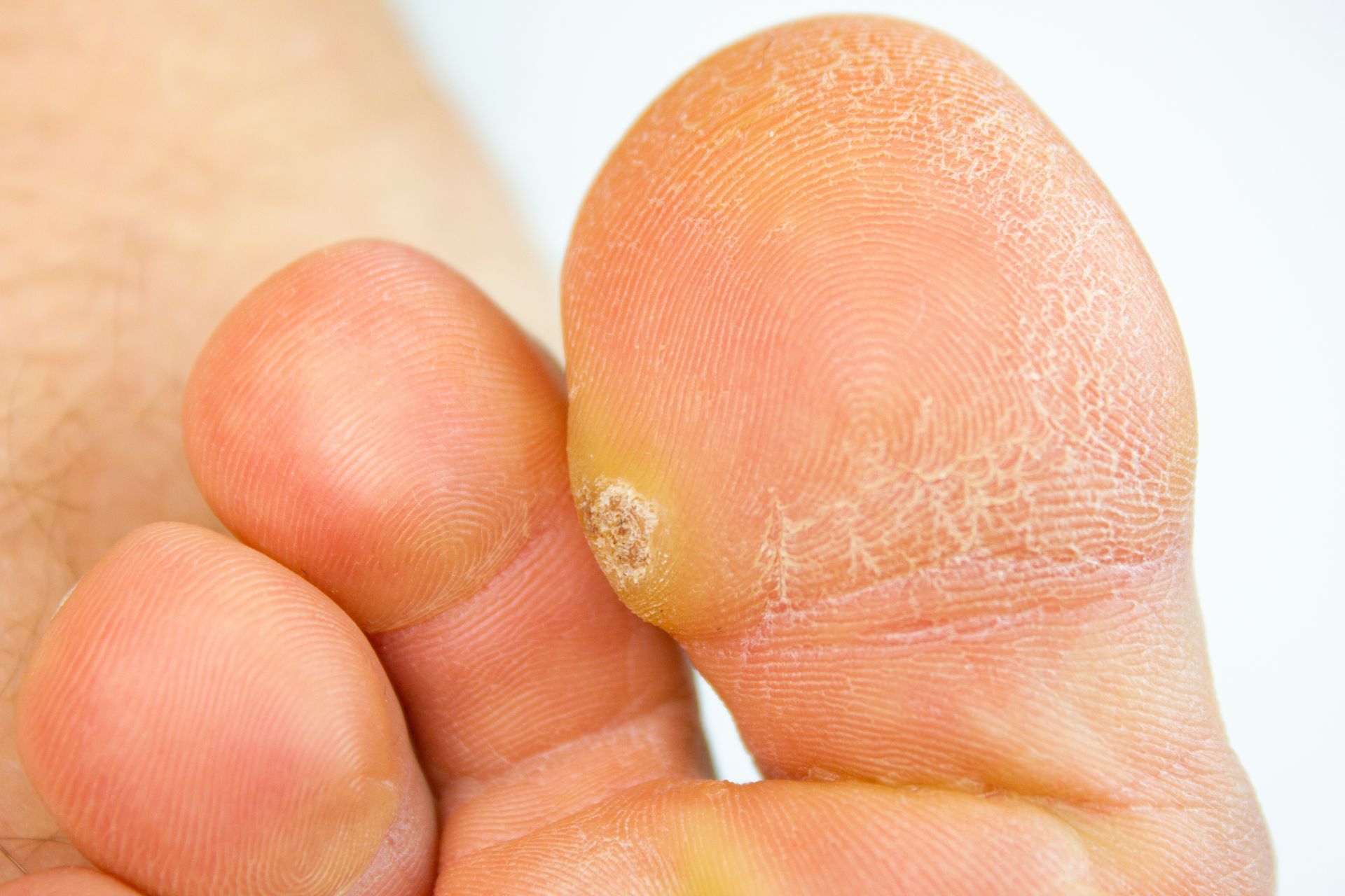 Foot with wart on the toe, cracked skin on the ball of the foot.