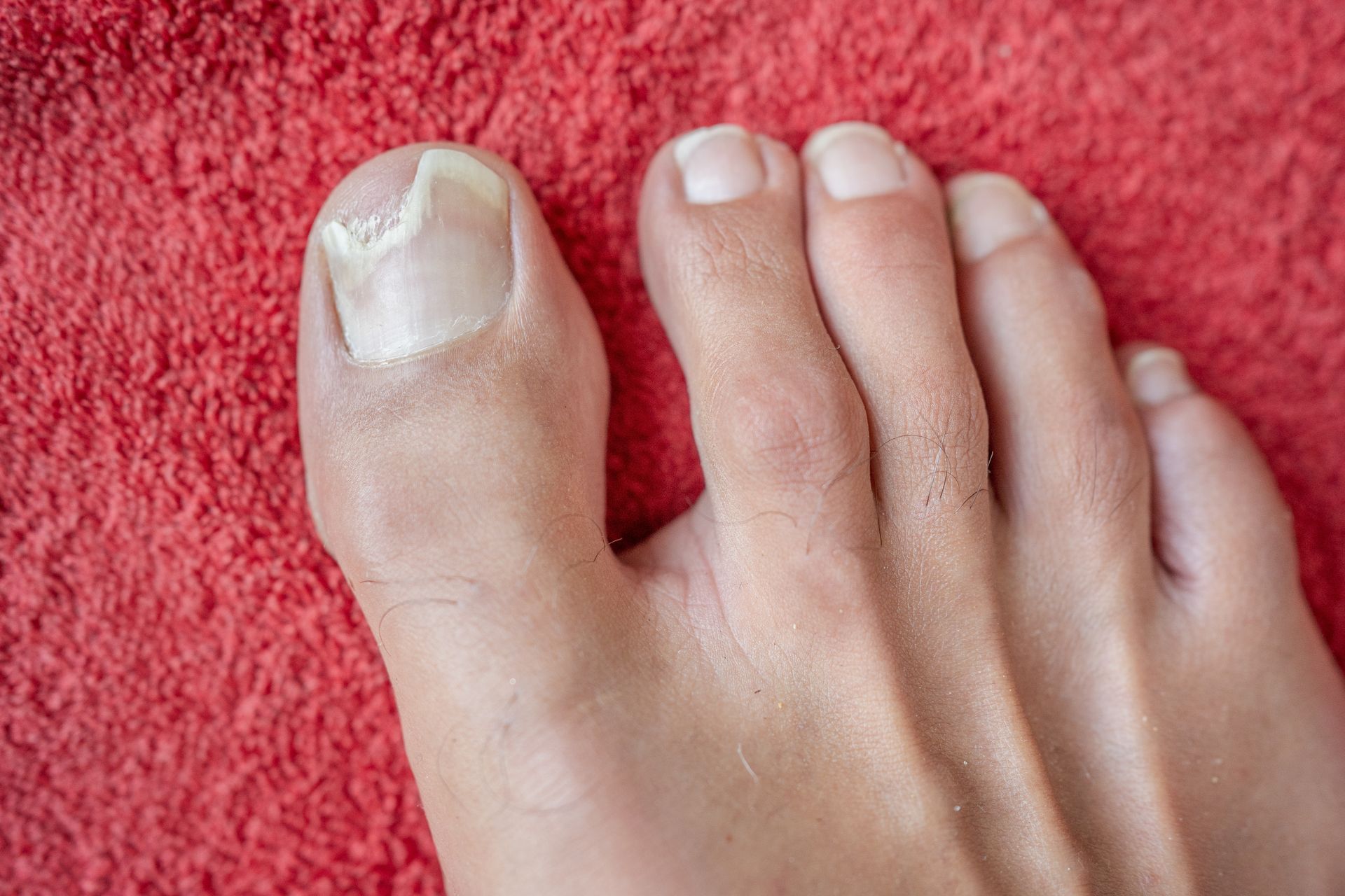 Foot with toenails, the big toe's nail is white and thick, possibly fungal infection, resting on red fabric.