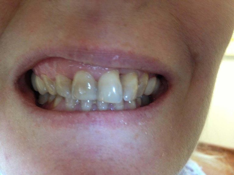 Caso con forte discromia dello smalto e disallineamento fra i vari elementi dentali