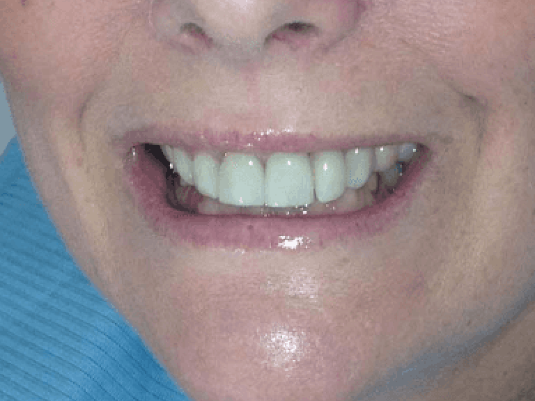Caso con forte discromia dello smalto e disallineamento fra i vari elementi dentali
