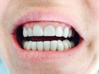 smalto di colore grigio scuro a causa dell’uso di tetracicline in età giovanile