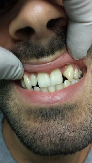 Riabilitazione protesica con corone in zirconio altamente estetiche