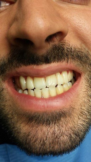 Riabilitazione protesica con corone in zirconio altamente estetiche