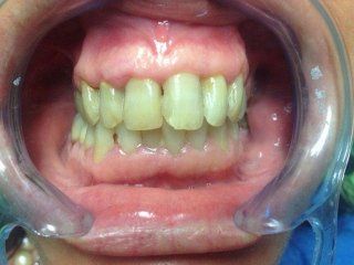 Esempio di riabilitazione protesica dell’arcata superiore con n. 6 faccette dentali da canino a canino