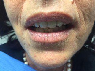 Esempio di riabilitazione protesica dell’arcata superiore con n. 6 faccette dentali da canino a canino