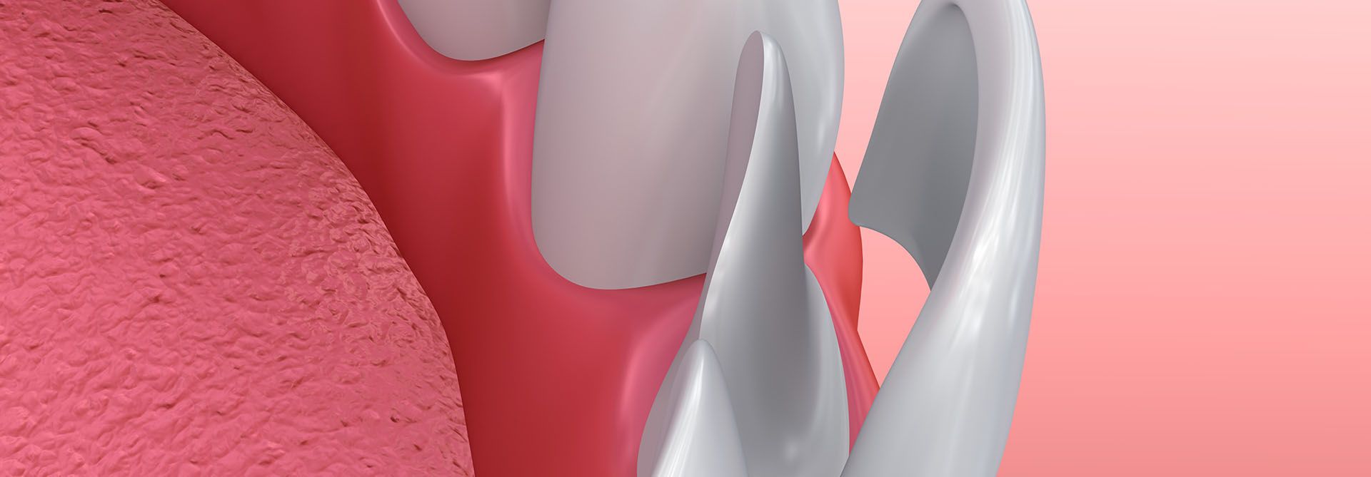 FACCETTE DENTALI