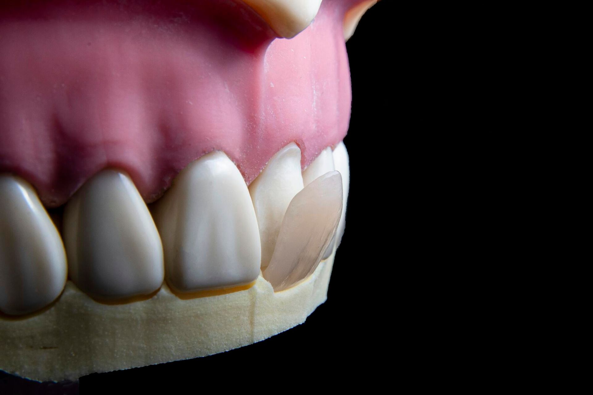 Mockup of dental veneers on artificial teeth; pink gums, black background.