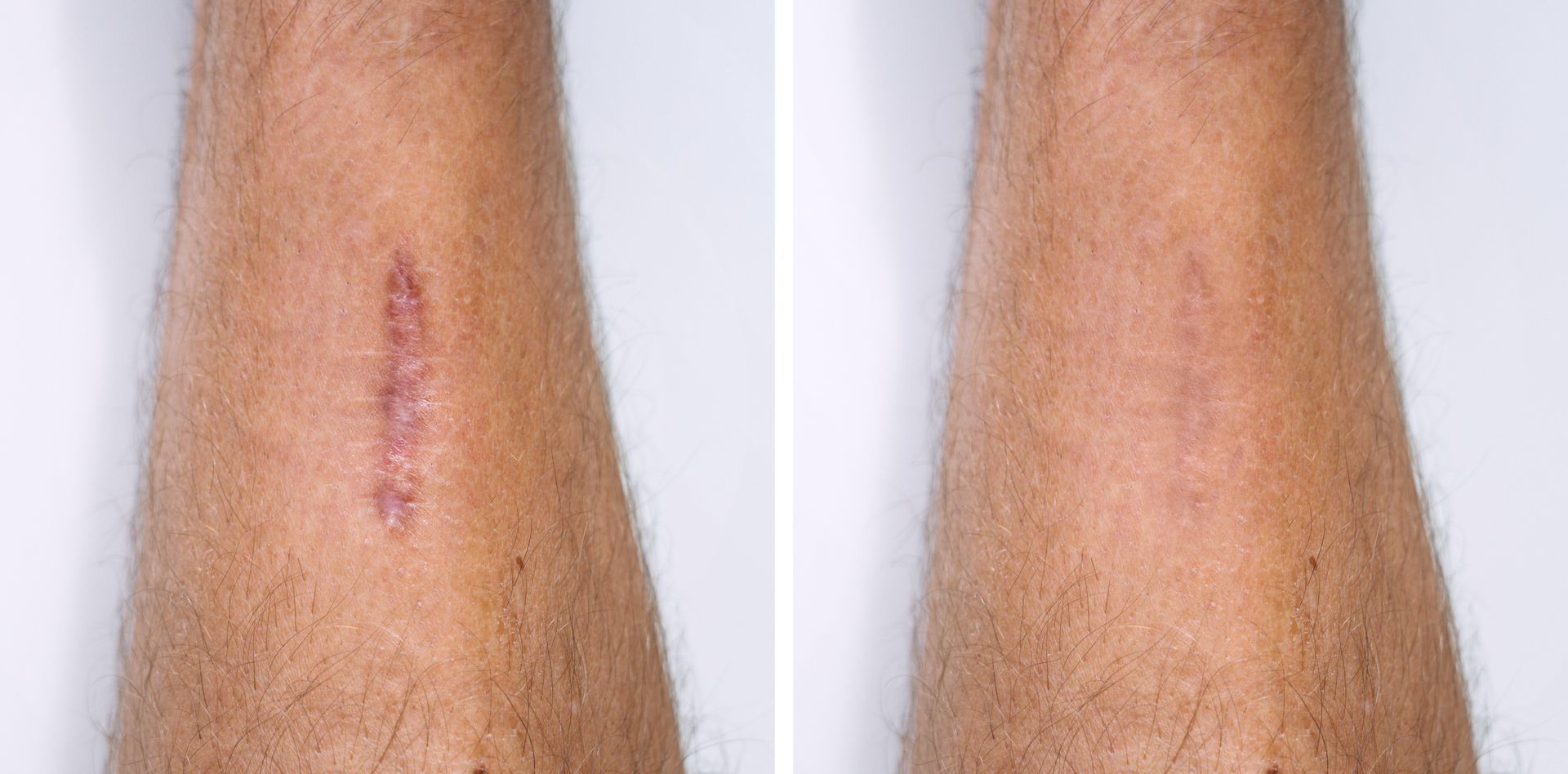 Side-by-side comparison of a scar on an arm before and after a treatment, showing a reduction in redness and visibility.