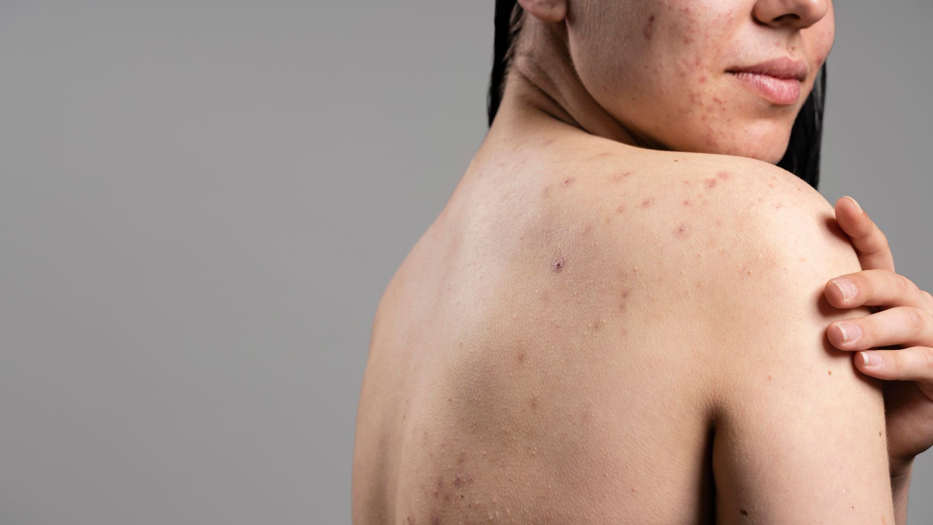 Close-up of a person’s bare shoulder and upper back with visible acne spots against a gray background