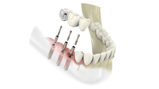 Implantate
