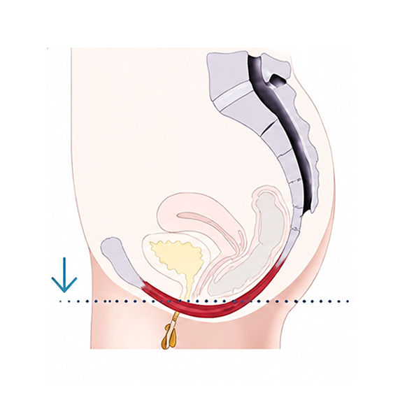 Sagittal pelvic medical diagram showing a catheter or probe inserted into the vagina.