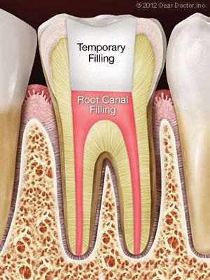 A diagram of a tooth with temporary filling and root canal filling