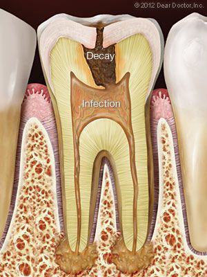 An illustration of a tooth with decay and infection