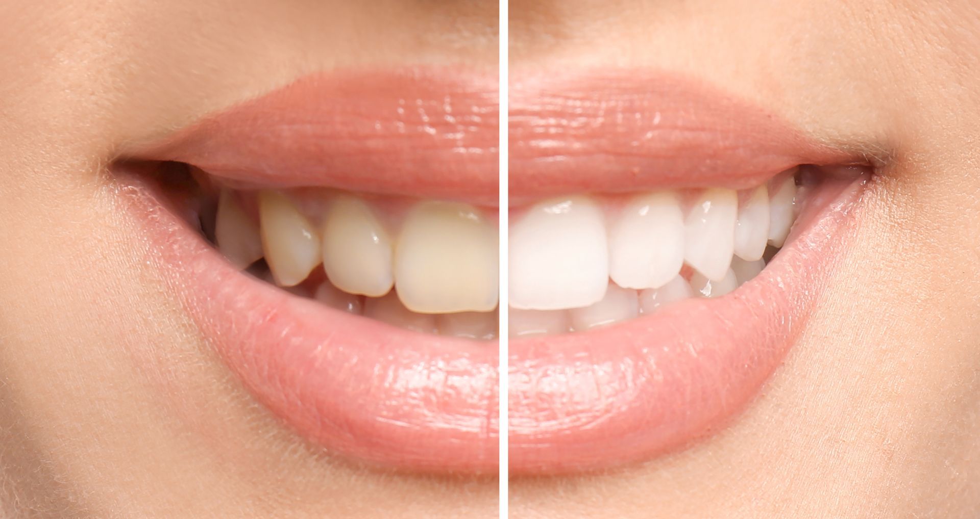 Woman smiling during a professional teeth whitening treatment at a dental office. Woman smiling during a professional teeth whitening treatment at a dental office.